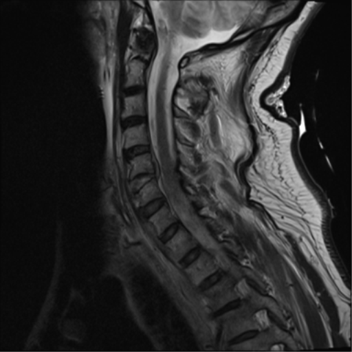 File:Blunt cerebrovascular injury (Radiopaedia 53682-59744 Sagittal T2 10).png