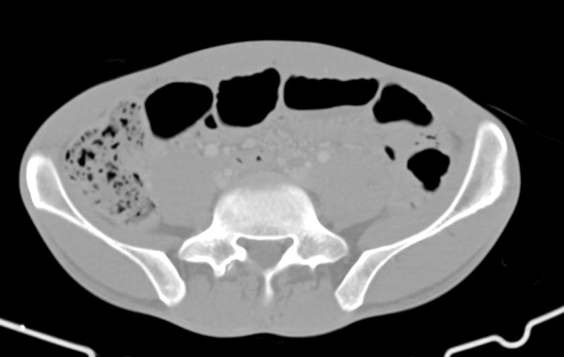 Blunt injury to the small bowel (Radiopaedia 74953-85987 Axial Wide 66).jpg