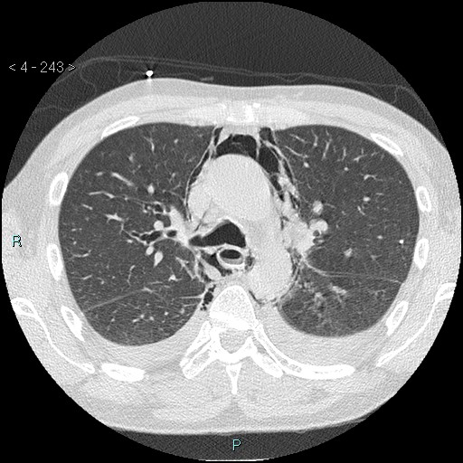Boerhaave syndrome (Radiopaedia 27683-27897 lung window 5).jpg