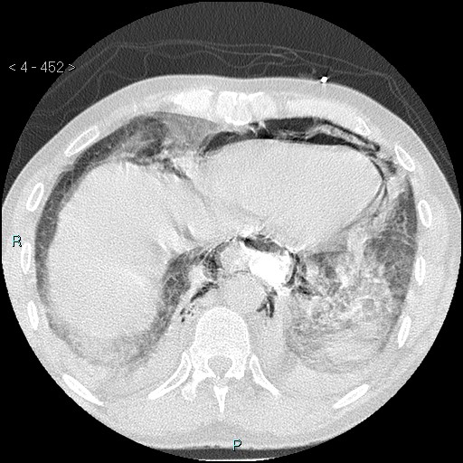 Boerhaave syndrome (Radiopaedia 27683-27897 lung window 84).jpg