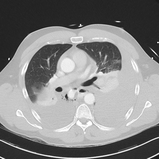 Boerhaave syndrome (Radiopaedia 39382-41661 Axial lung window 26).png