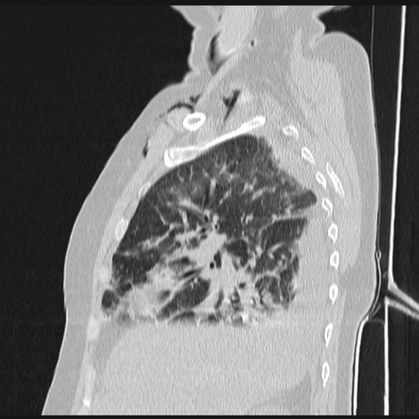 Boerhaave syndrome (Radiopaedia 45644-49799 Sagittal lung window 23).jpg