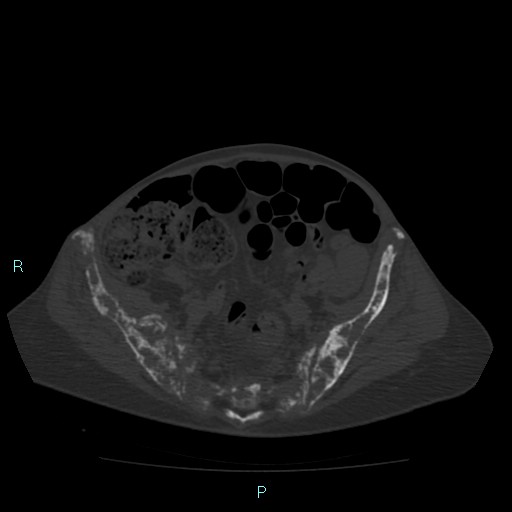 File:Bone metastases from untreated breast cancer (Radiopaedia 42973-46219 Axial bone window 157).jpg