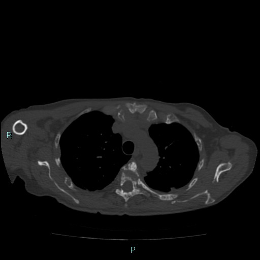Bone metastases from untreated breast cancer (Radiopaedia 42973-46219 Axial bone window 28).jpg