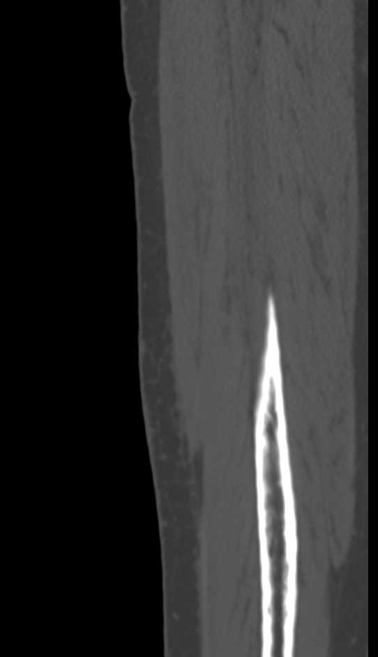 Bone metastasis - tibia (Radiopaedia 57665-64609 Sagittal bone window 151).jpg