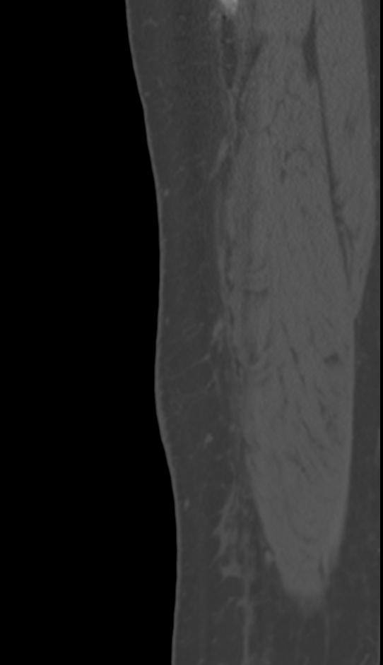 Bone metastasis - tibia (Radiopaedia 57665-64609 Sagittal bone window 20).jpg