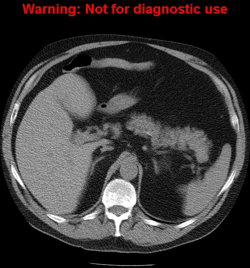 File:Bosniak renal cyst - type IV (Radiopaedia 23402-23466 Axial non-contrast 3).jpg