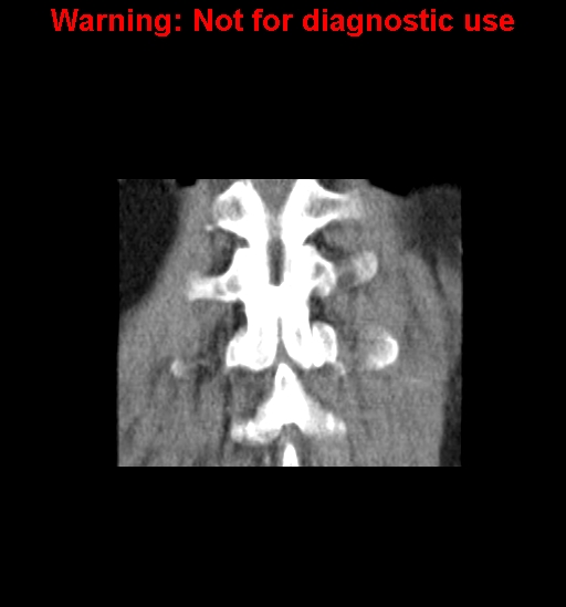 File:Bosniak renal cyst - type IV (Radiopaedia 23402-23466 C 30).jpg