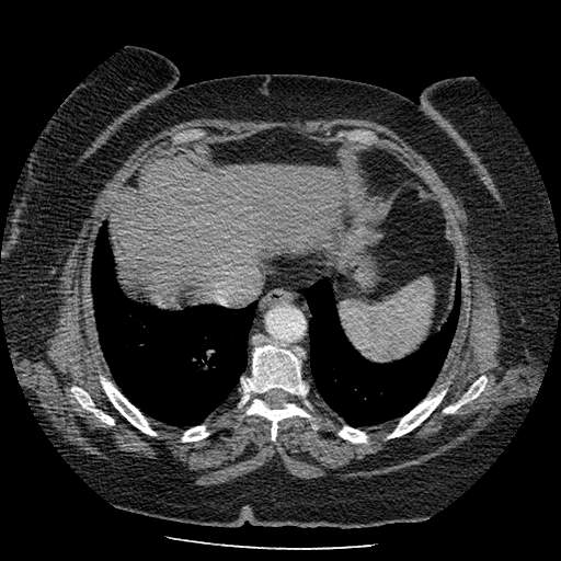 Bovine aortic arch - right internal mammary vein drains into the superior vena cava (Radiopaedia 63296-71875 A 125).jpg