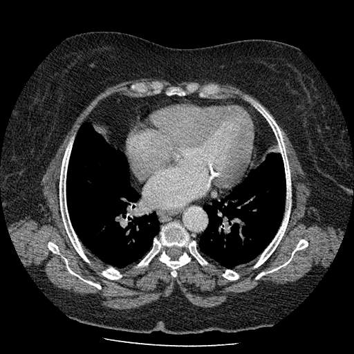 Bovine aortic arch - right internal mammary vein drains into the superior vena cava (Radiopaedia 63296-71875 A 95).jpg