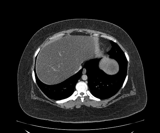 Bowel and splenic infarcts in acute lymphocytic leukemia (Radiopaedia 61055-68913 A 20).jpg