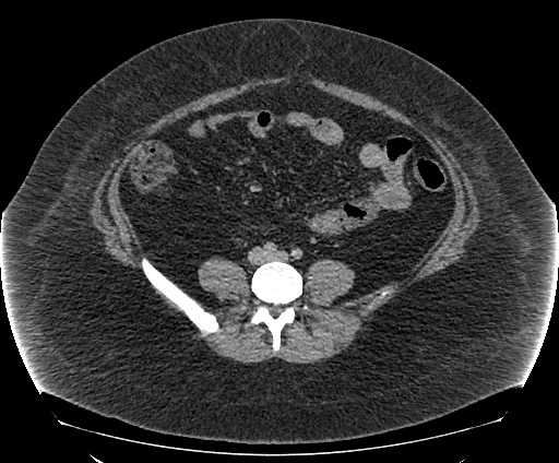 Bowel and splenic infarcts in acute lymphocytic leukemia (Radiopaedia 61055-68913 A 83).jpg