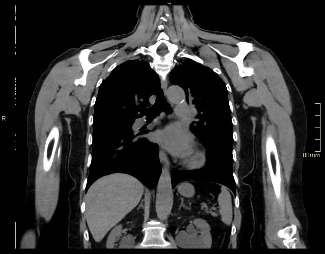 Brachial artery foreign body (Radiopaedia 54583-60820 Coronal non-contrast 33).jpg