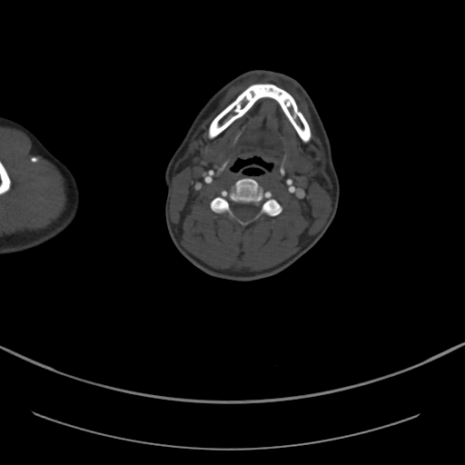 File:Brachiocephalic trunk pseudoaneurysm (Radiopaedia 70978-81191 Axial bone window 14).jpg
