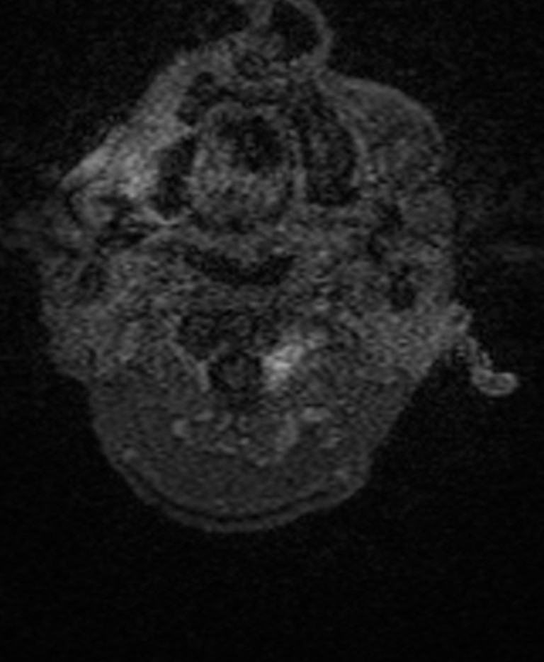 Brain abscess with dual rim sign (Radiopaedia 87566-103938 Axial T1 C+ 2).jpg