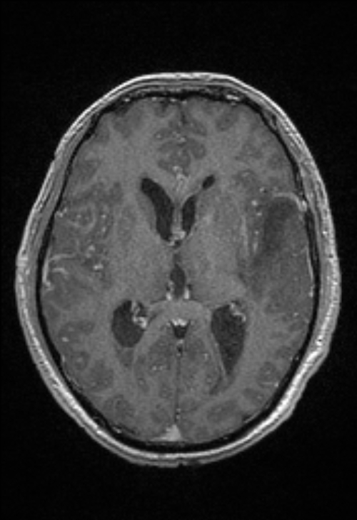 Brain abscess with ventriculitis (Radiopaedia 85703-101495 Axial T1 C+ 94).jpg