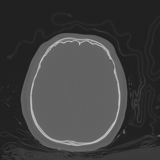 File:Brain contusions, internal carotid artery dissection and base of skull fracture (Radiopaedia 34089-35339 Axial bone window 84).png