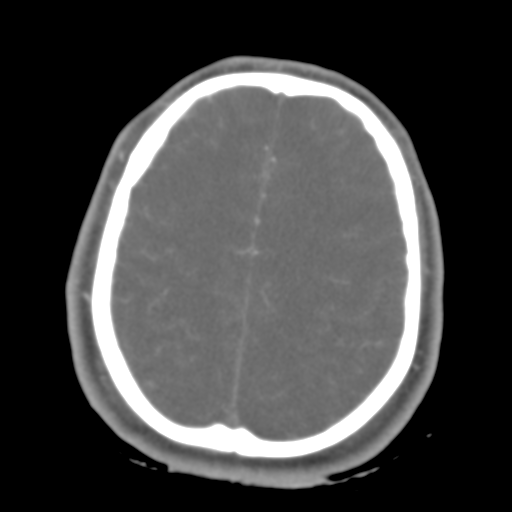 Brain contusions, internal carotid artery dissection and base of skull fracture (Radiopaedia 34089-35339 D 14).png