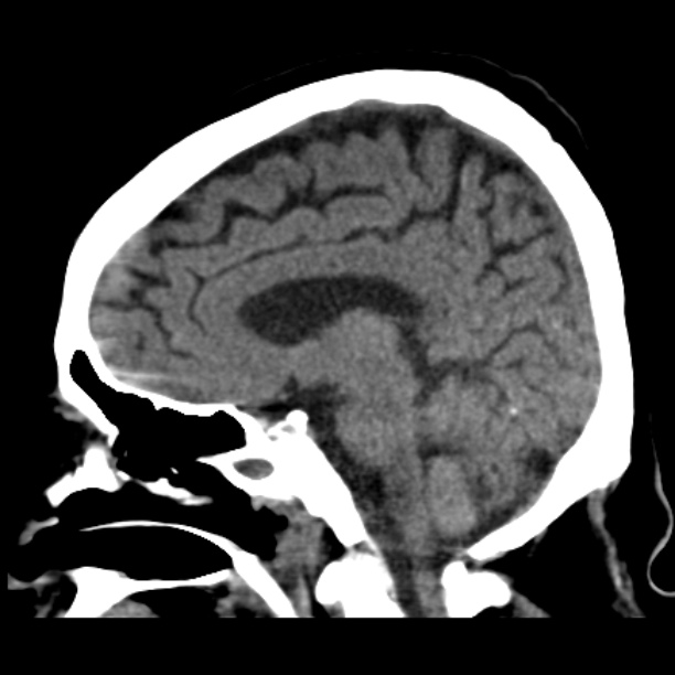 Brain cortical laminar necrosis (Radiopaedia 25822-25971 non-contrast 24).jpg