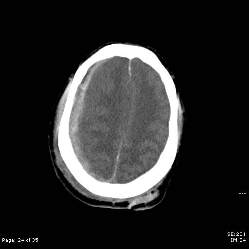 File:Brain death after motor vehicle collision (Radiopaedia 88470-105114 Axial non-contrast 24).jpg