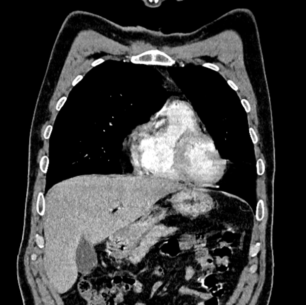 Brain metastases - lung cancer primary (Radiopaedia 75060-86116 C+ arterial phase 15).jpg