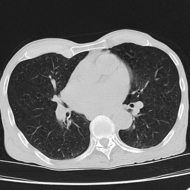 Brain metastases from lung cancer (Radiopaedia 27849-28093 Axial lung window 36).jpg
