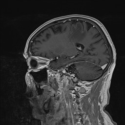 Brain metastasis (Radiopaedia 42617-45761 Sagittal T1 C+ 35).jpg