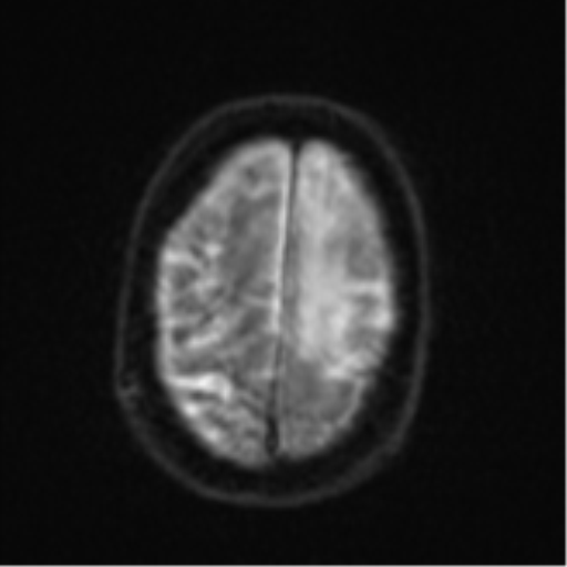 File:Brain metastasis (lung cancer) (Radiopaedia 48289-53179 Axial DWI 24).png