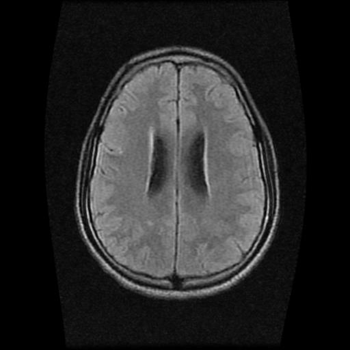 File:Brainstem glioma (Radiopaedia 30923-31624 Axial FLAIR 16).jpg