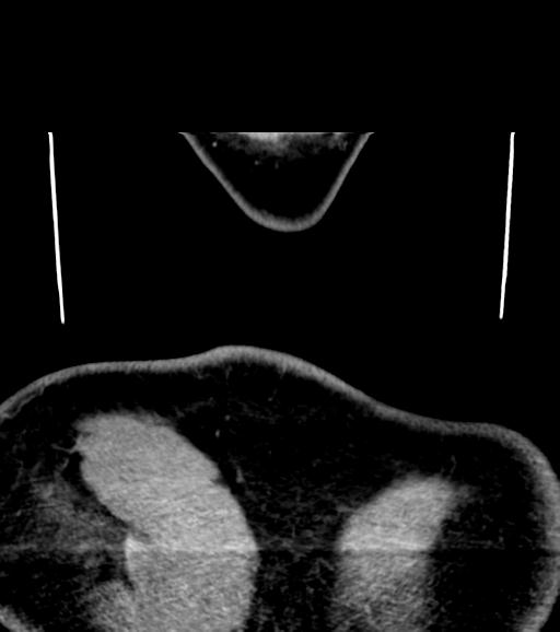 Branchial cleft cyst (Radiopaedia 31167-31875 Coronal C+ delayed 67).jpg