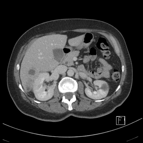 Breast metastases from renal cell cancer (Radiopaedia 79220-92225 C 34).jpg