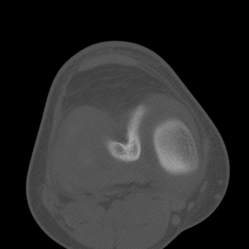 Brodie abscess of the tibia (Radiopaedia 58984-66250 Axial bone window 53).jpg