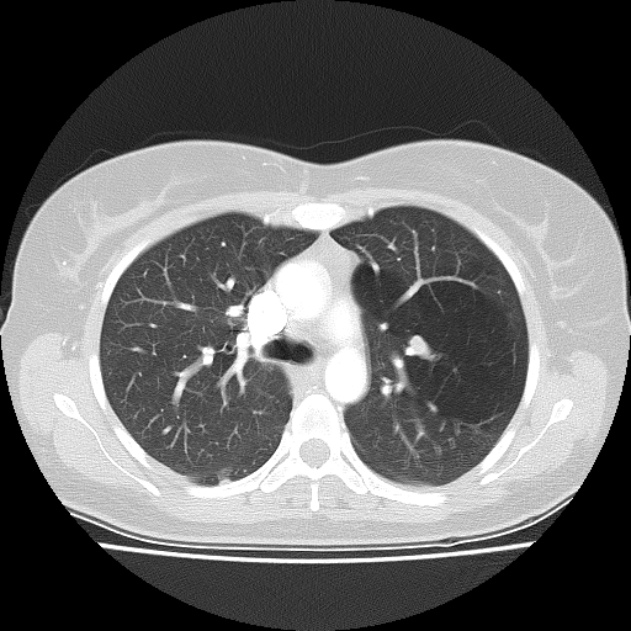 Bronchial atresia (Radiopaedia 22965-22992 Axial lung window 33).jpg