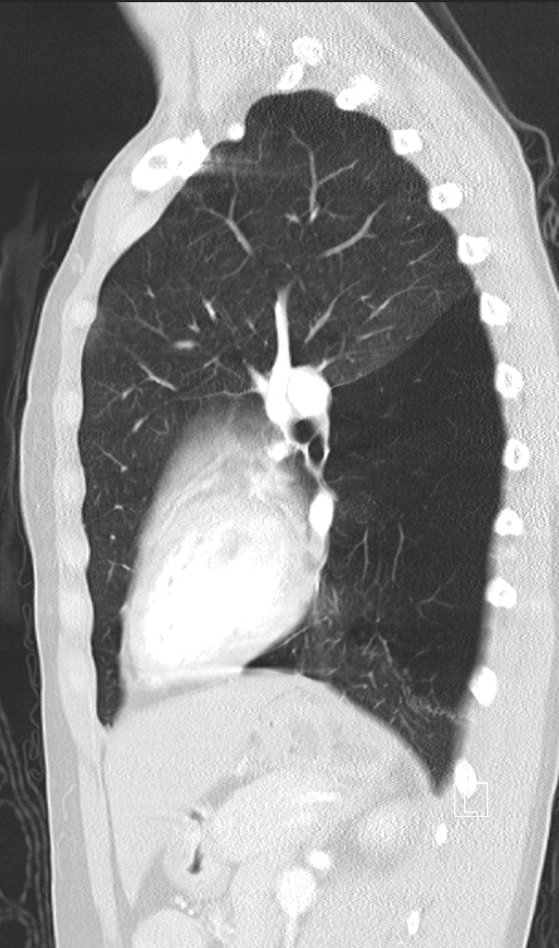 Bronchial atresia (Radiopaedia 73677-84470 Sagittal lung window 34).jpg