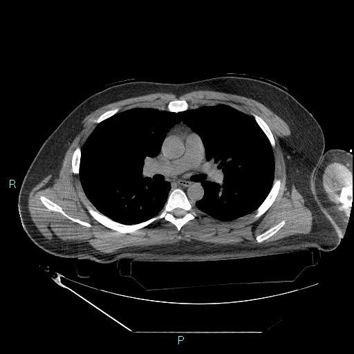 File:Bronchial carcinoid tumor (Radiopaedia 78272-90870 Axial non-contrast 46).jpg