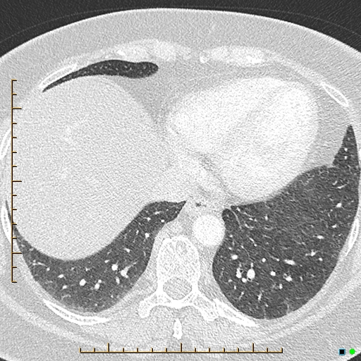 Bronchial diverticula (Radiopaedia 79512-92676 Axial lung window 161).jpg