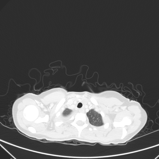 Bronchial mucoepidermoid carcinoma (Radiopaedia 57023-63895 Axial lung window 2).jpg