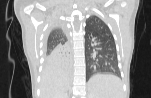 Bronchial mucoepidermoid carcinoma (Radiopaedia 57023-63895 Coronal lung window 68).jpg