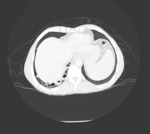 File:Bronchiectasis in Crohn disease (Radiopaedia 60311-67977 Axial lung window 25).jpg