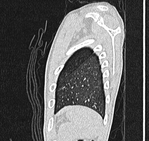 Bronchiolitis obliterans (Radiopaedia 71538-81897 Sagittal lung window 64).jpg