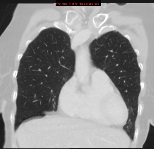 File:Bronchoalveolar carcinoma (BAC) (Radiopaedia 13436-13392 Coronal lung window 16).jpg