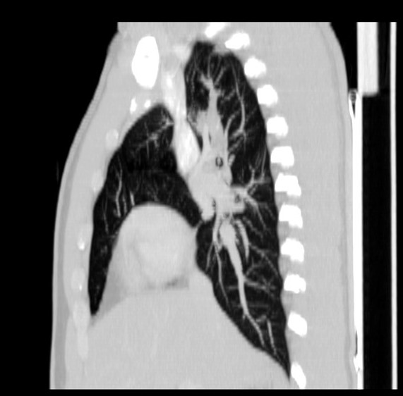 File:Bronchocele (Radiopaedia 12104-12460 Sagittal lung window 2).jpg