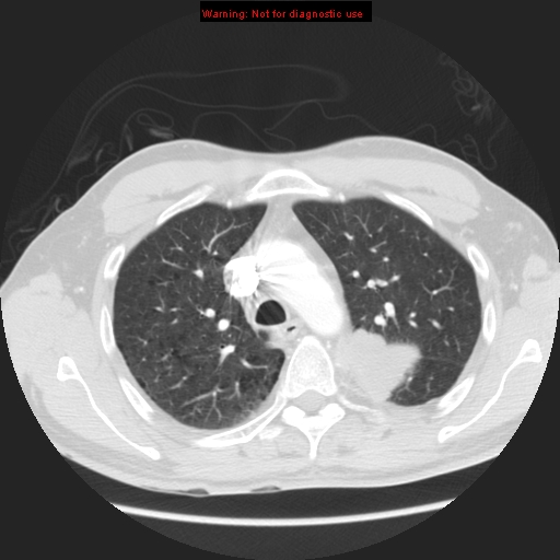 File:Bronchogenic carcinoma brain metastasis (Radiopaedia 9286-105832 Axial lung window 18).jpg