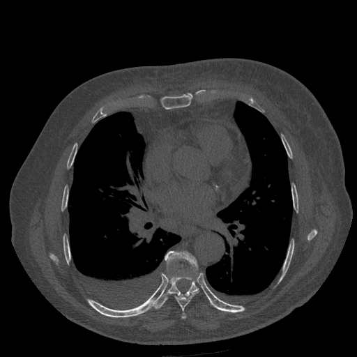 Bronchogenic carcinoma with metastatic lymphadenopathy (Radiopaedia 37671-39569 Axial bone window 32).jpg