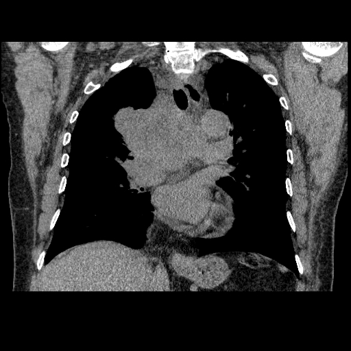 File:Bronchogenic carcinoma with metastatic lymphadenopathy (Radiopaedia 37671-39569 Coronal non-contrast 25).jpg