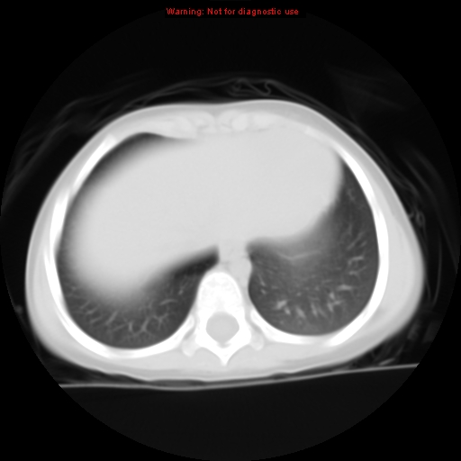 File:Bronchogenic cyst (Radiopaedia 9372-10063 Axial lung window 13).jpg