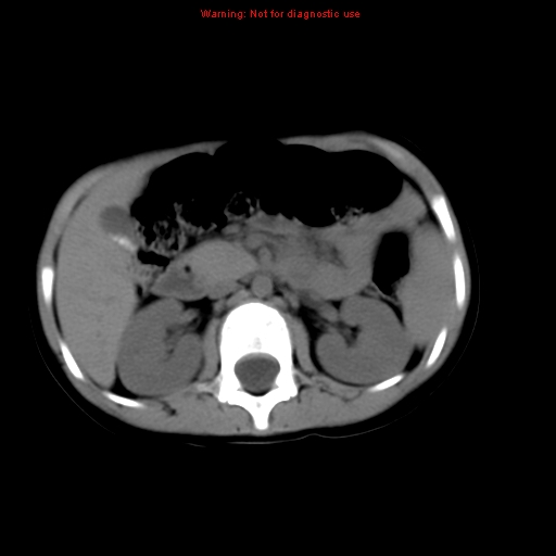 File:Bronchogenic cyst (Radiopaedia 9372-10063 Axial non-contrast 21).jpg