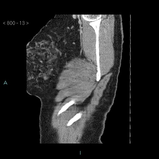 Bronchogenic cyst - posterior mediastinal (Radiopaedia 43885-47364 B 8).jpg