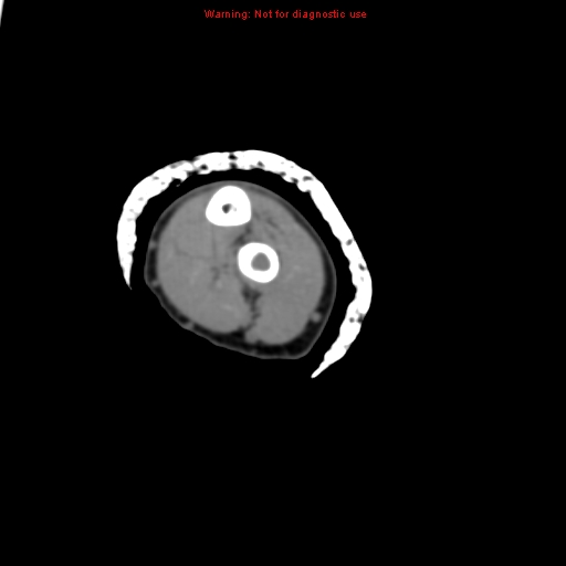 Brown tumor (Radiopaedia 12460-12694 Axial non-contrast 108).jpg