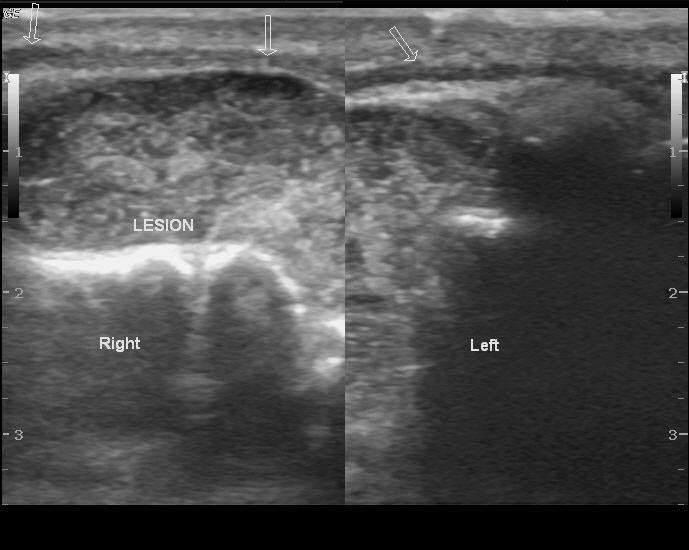 File:Buccal mucosal retention cyst on sonography (Radiopaedia 12196-12521 C 1).jpg